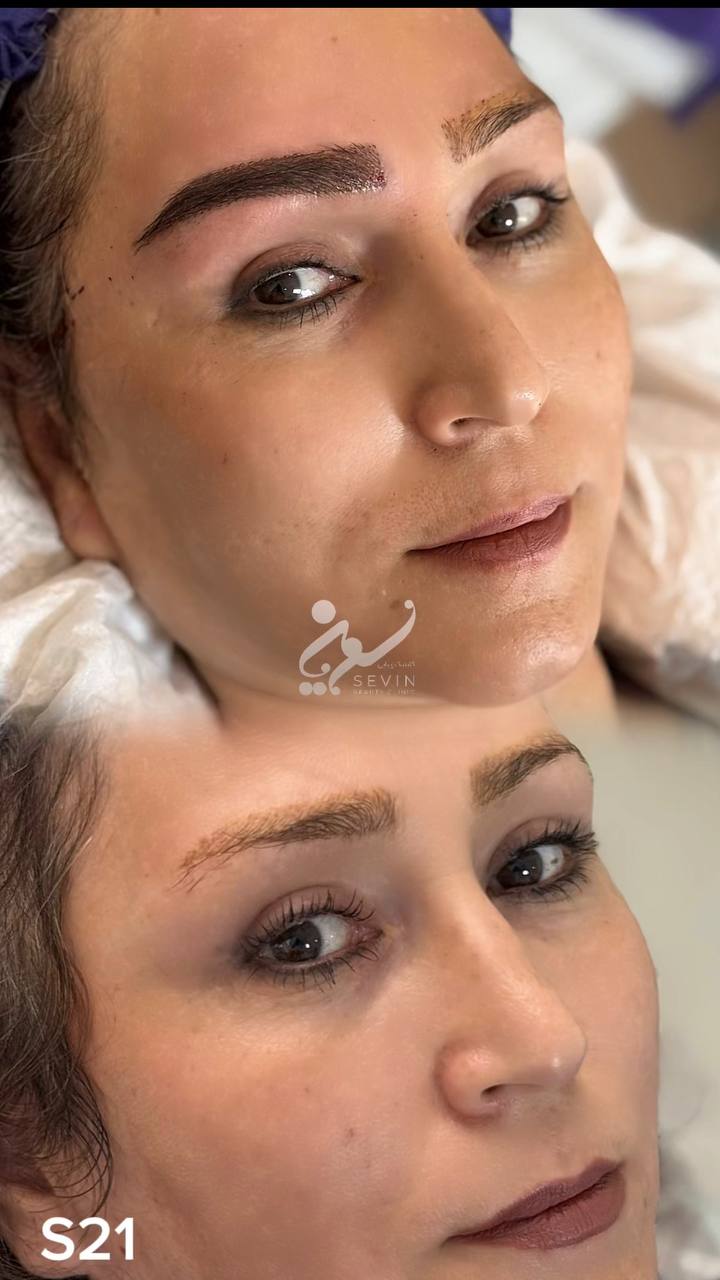 نمونه کاشت ابرو در کلینیک سوین